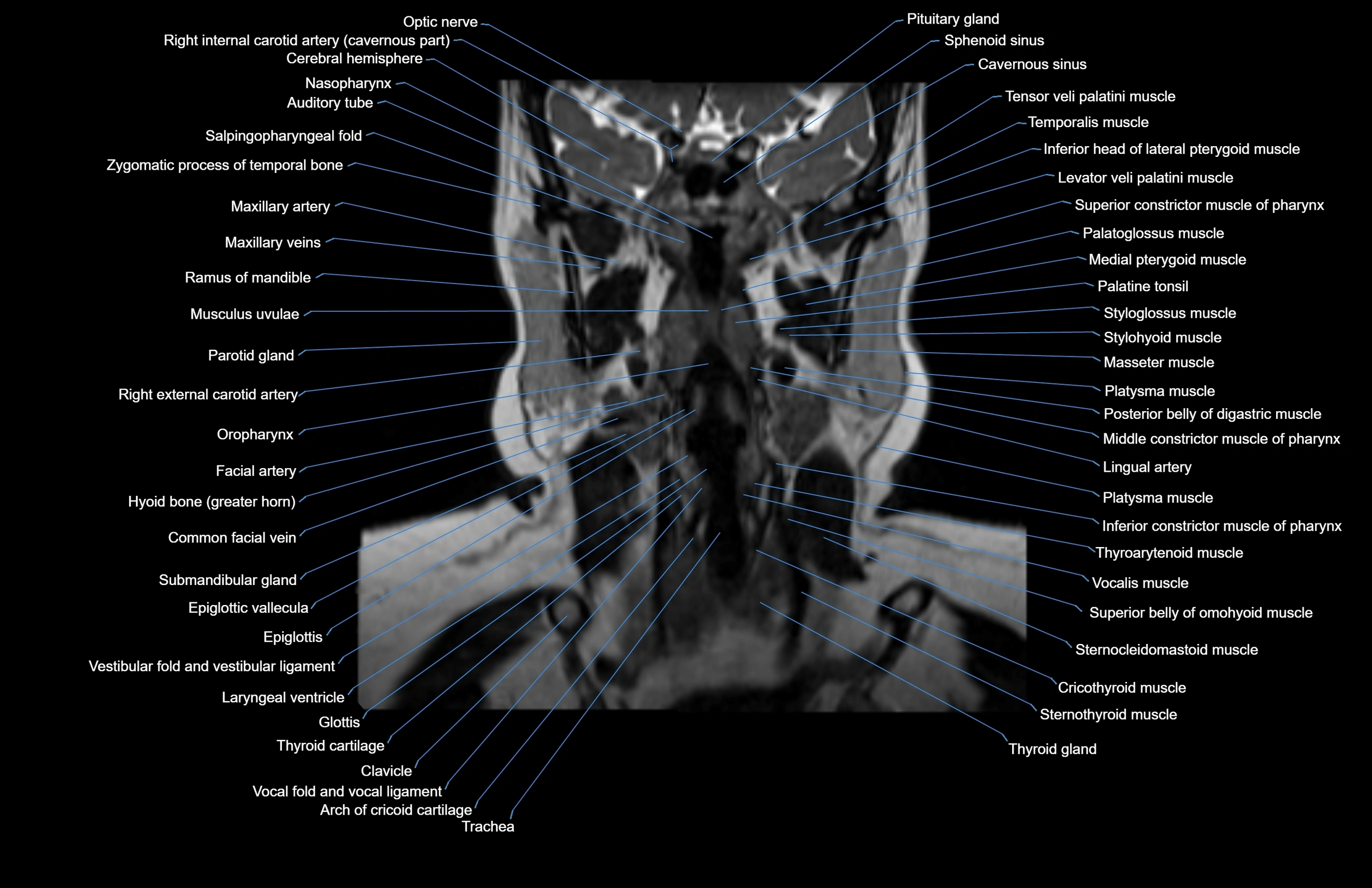 Neck coronal cross sectional MRI anatomy 3T MRI  image-img-00001-00043.webp